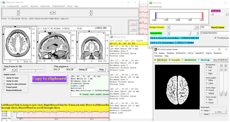 Figure 27 - Post-neurofeedback eyes-open z-score LORETA analysis for 20 Hz